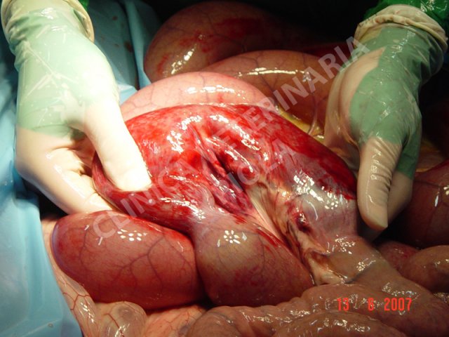 Strangolamento da lipoma peduncolato 1